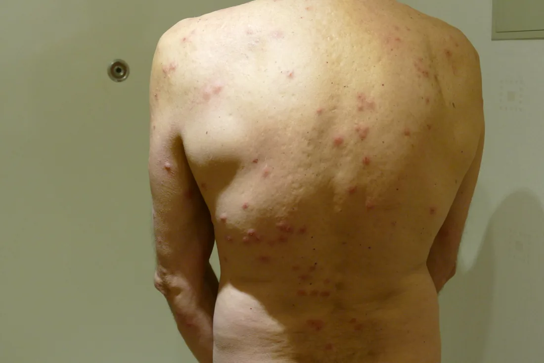 Schiena con decine di punture di cimice dei letti sparse e raggruppate